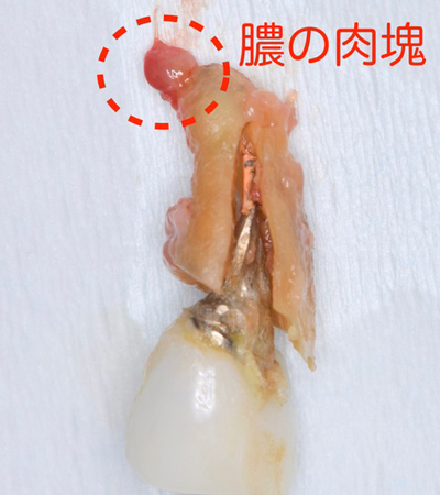 インプラントを受けられる方は寝ながら点滴麻酔鎮静は無料　東大阪　奈良市　生駒市　骨の先端再生治療