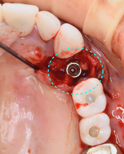 インプラントを受けられる方は寝ながら点滴麻酔鎮静は無料　東大阪　奈良市　生駒市　骨の先端再生治療