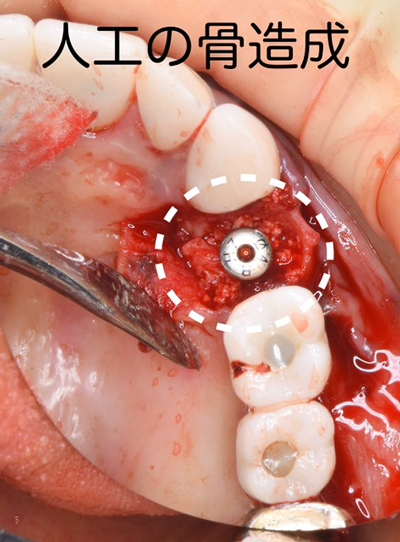 インプラントを受けられる方は寝ながら点滴麻酔鎮静は無料　東大阪　奈良市　生駒市　骨の先端再生治療