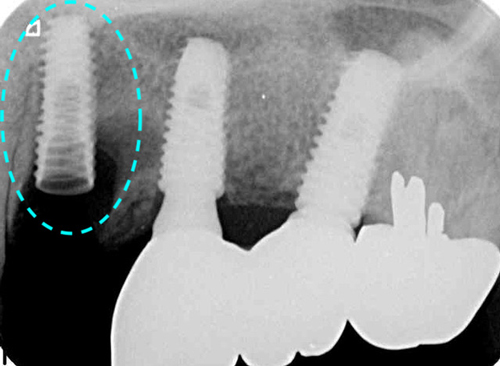 インプラントを受けられる方は寝ながら点滴麻酔鎮静は無料　東大阪　奈良市　生駒市　骨の先端再生治療