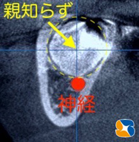 奈良　生駒　西大寺　学園前　石切　寝ながら保険横向き親知らず抜歯　難しい神経近い　コラーゲン再生療法