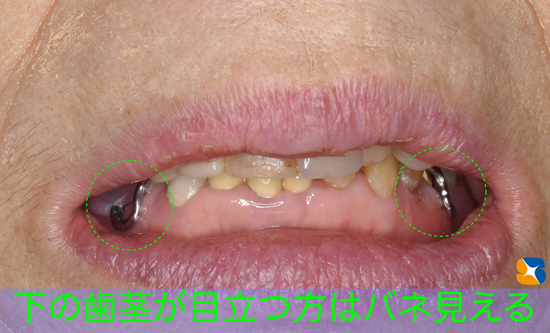 大阪　石切　保険　目立たない保険の入れ歯　装着感良い　優れた入れ歯　奈良