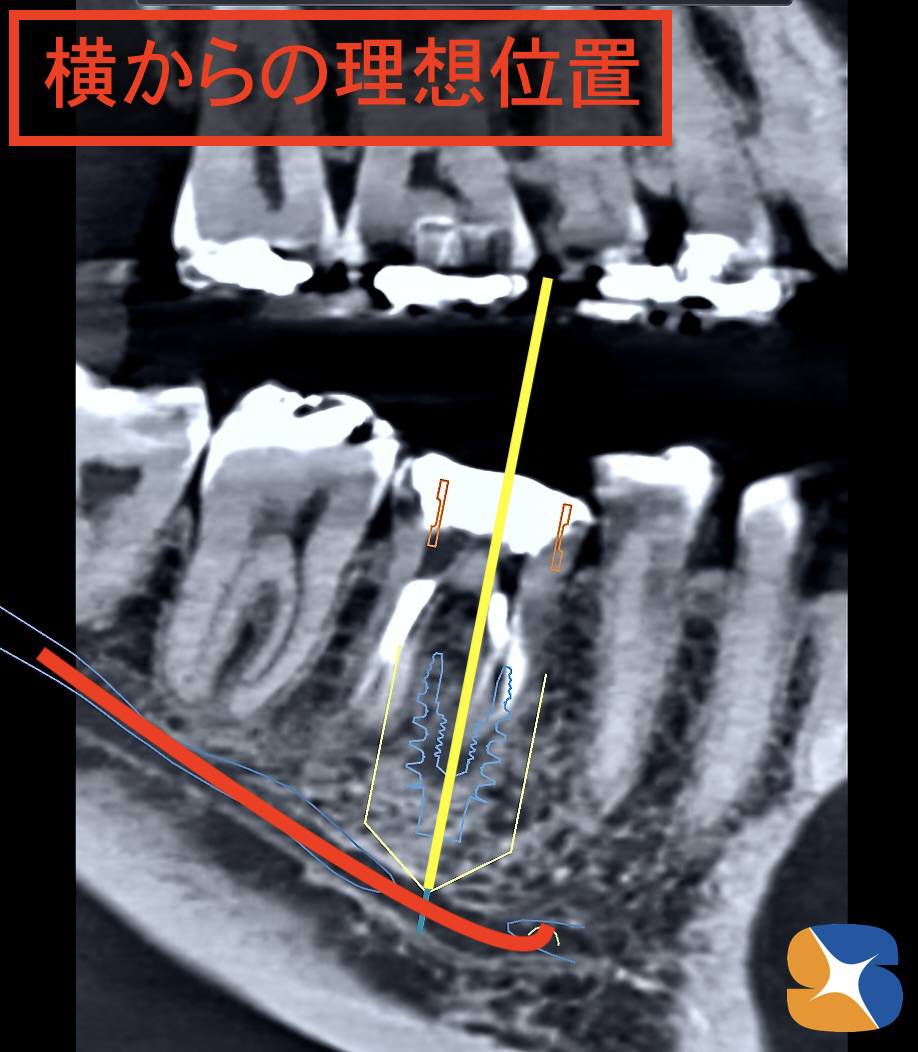 鈴木歯科医院　最先端医療技術インプラントガイド　神経を傷つけない　ドリルの角度に狂いがない　大阪　奈良　再生医療CGFコラーゲン付き手術　後悔しないインプラント