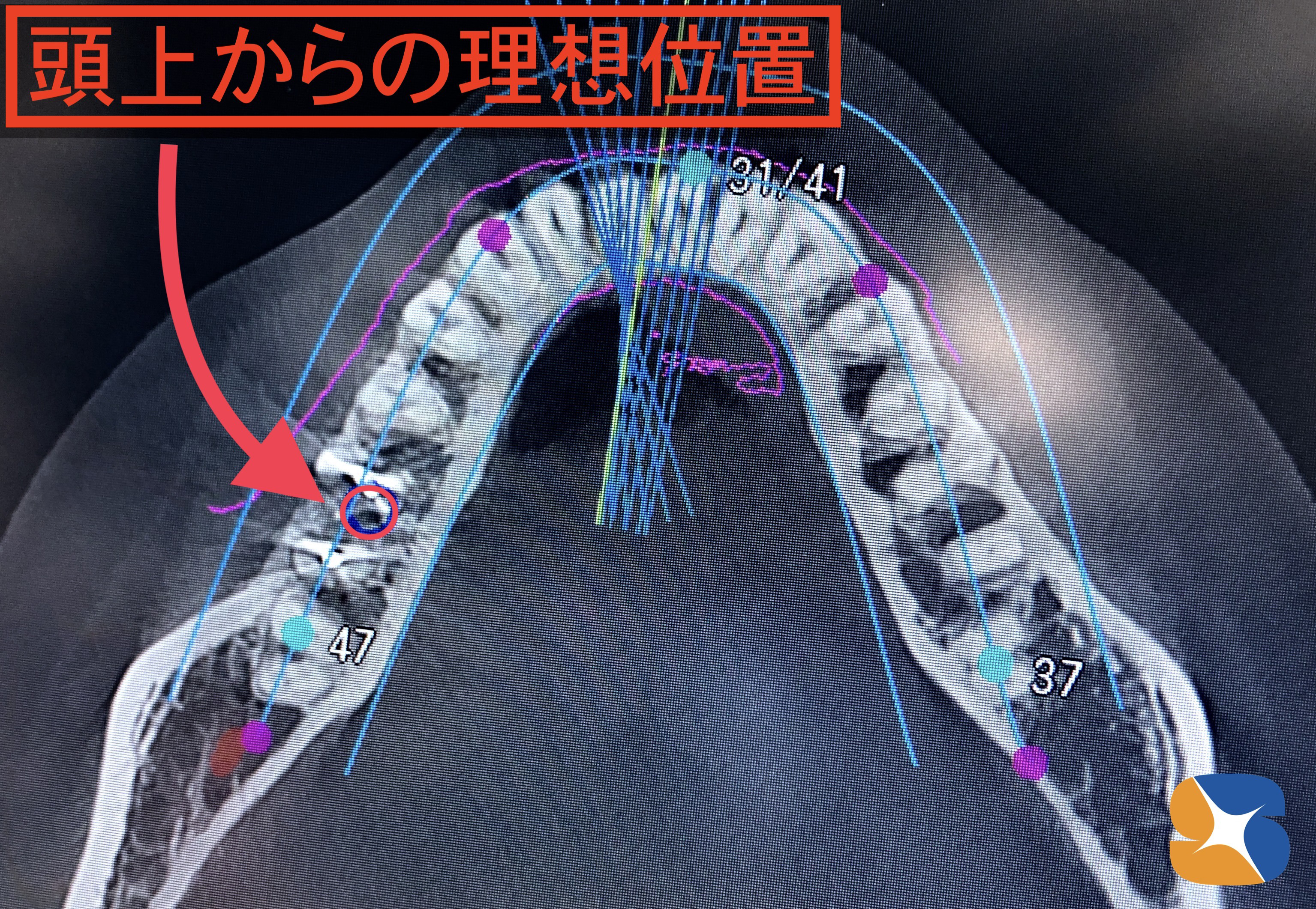 鈴木歯科医院　最先端医療技術インプラントガイド　神経を傷つけない　ドリルの角度に狂いがない　大阪　奈良　再生医療CGFコラーゲン付き手術　後悔しないインプラント