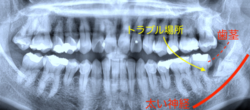 奈良　生駒　西大寺　学園前　横向き難しい親知らず　難しい抜歯　静脈麻酔鎮静法を保険で実地　抜歯後の早期回復コラーゲン再生医療もセットで無料　