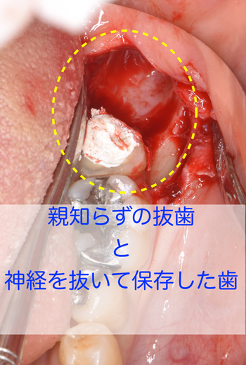 奈良　生駒　西大寺　学園前　横向き難しい親知らず　難しい抜歯　静脈麻酔鎮静法を保険で実地　抜歯後の早期回復コラーゲン再生医療もセットで無料　