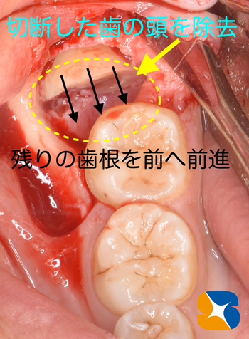 怖くない抜歯　難しい親知らず　保険で寝ながら　奈良　生駒　東大阪　コラーゲン再生療法　腫れさせない歯科医院