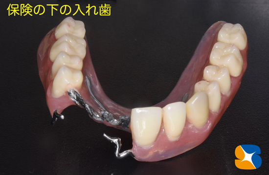 奈良　学園前　生駒　石切　東大阪　保険で最高の入れ歯　目立たない入れ歯　快適入れ歯　材料を惜しみなく使うスペシャル保険入れ歯