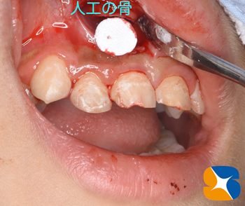 鈴木歯科医院　大阪　奈良　石切　再生医療　