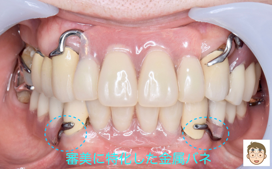 奈良　学園前　生駒　石切　東大阪　保険で最高の入れ歯　目立たない入れ歯　快適入れ歯　材料を惜しみなく使うスペシャル保険入れ歯