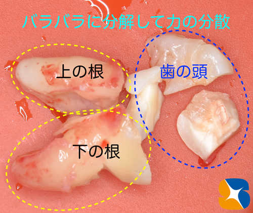 石切駅前　鈴木歯科医院　静脈麻酔鎮静保険抜歯　再生医療コラーゲンゲル　手に汗握る抜歯を寝ながら施術　コラム実例多数　最新CTで要チェック