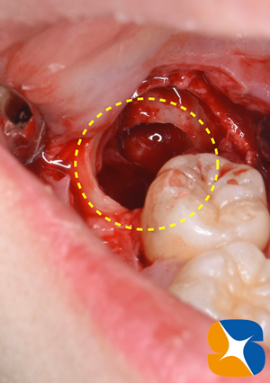 石切駅前　鈴木歯科医院　静脈麻酔鎮静保険抜歯　再生医療コラーゲンゲル　手に汗握る抜歯を寝ながら施術　コラム実例多数　最新CTで要チェック