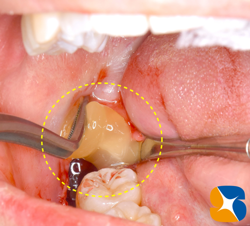 石切駅前　鈴木歯科医院　静脈麻酔鎮静保険抜歯　再生医療コラーゲンゲル　手に汗握る抜歯を寝ながら施術　コラム実例多数　最新CTで要チェック
