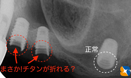 東大阪　奈良　石切駅前　鈴木歯科　ブルーラジカル　静脈麻酔鎮静　寝ながらリラックス　歯周病　インプラント　失った骨の再生医療　血液コラーゲン　歯科用最新CT精度が高い　正確な診査と診断 経験豊富