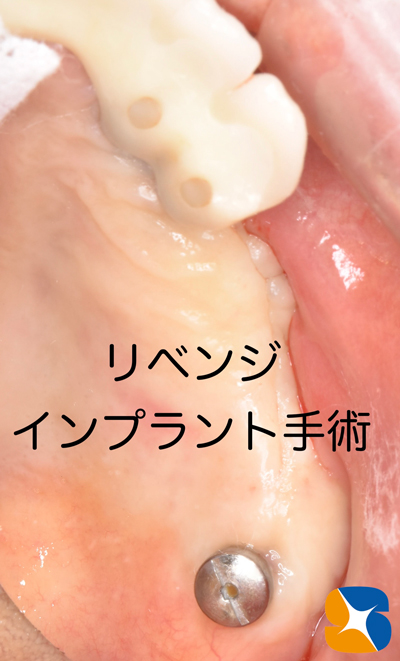 東大阪　奈良　石切駅前　鈴木歯科　ブルーラジカル　静脈麻酔鎮静　寝ながらリラックス　歯周病　インプラント　失った骨の再生医療　血液コラーゲン　歯科用最新CT精度が高い　正確な診査と診断 経験豊富