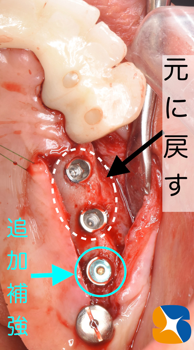 東大阪　奈良　石切駅前　鈴木歯科　ブルーラジカル　静脈麻酔鎮静　寝ながらリラックス　歯周病　インプラント　失った骨の再生医療　血液コラーゲン　歯科用最新CT精度が高い　正確な診査と診断 経験豊富