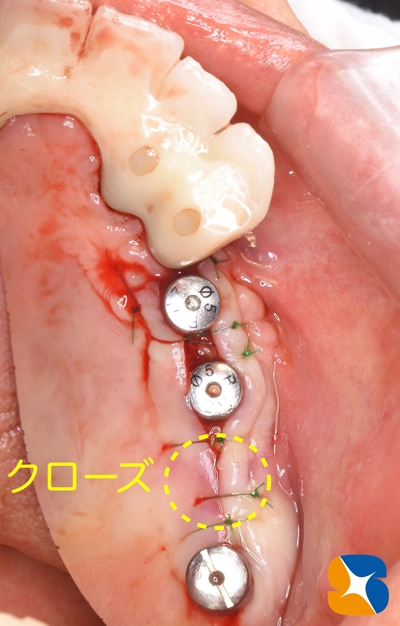 東大阪　奈良　石切駅前　鈴木歯科　ブルーラジカル　静脈麻酔鎮静　寝ながらリラックス　歯周病　インプラント　失った骨の再生医療　血液コラーゲン　歯科用最新CT精度が高い　正確な診査と診断 経験豊富
