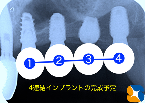 東大阪　奈良　石切駅前　鈴木歯科　ブルーラジカル　静脈麻酔鎮静　寝ながらリラックス　歯周病　インプラント　失った骨の再生医療　血液コラーゲン　歯科用最新CT精度が高い　正確な診査と診断 経験豊富