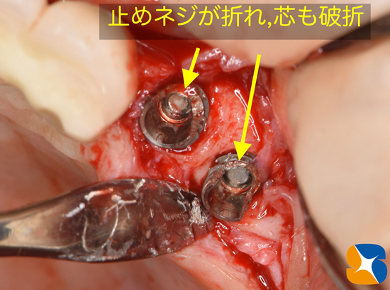 東大阪　奈良　石切駅前　鈴木歯科　ブルーラジカル　静脈麻酔鎮静　寝ながらリラックス　歯周病　インプラント　失った骨の再生医療　血液コラーゲン　歯科用最新CT精度が高い　正確な診査と診断 経験豊富