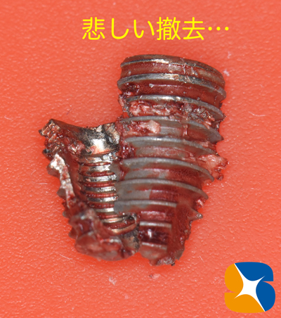 東大阪　奈良　石切駅前　鈴木歯科　ブルーラジカル　静脈麻酔鎮静　寝ながらリラックス　歯周病　インプラント　失った骨の再生医療　血液コラーゲン　歯科用最新CT精度が高い　正確な診査と診断 経験豊富