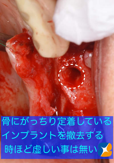 東大阪　奈良　石切駅前　鈴木歯科　ブルーラジカル　静脈麻酔鎮静　寝ながらリラックス　歯周病　インプラント　失った骨の再生医療　血液コラーゲン　歯科用最新CT精度が高い　正確な診査と診断 経験豊富