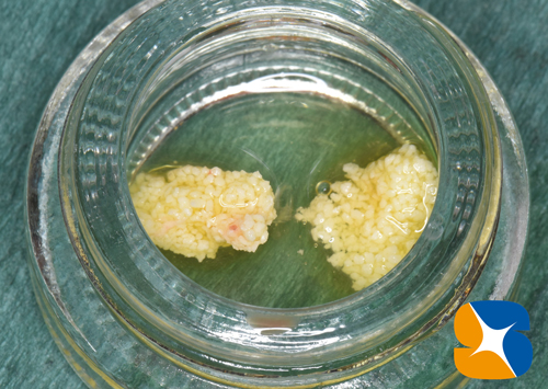 東大阪　奈良　石切駅前　鈴木歯科　ブルーラジカル　静脈麻酔鎮静　寝ながらリラックス　歯周病　インプラント　失った骨の再生医療　血液コラーゲン　歯科用最新CT精度が高い　正確な診査と診断 経験豊富