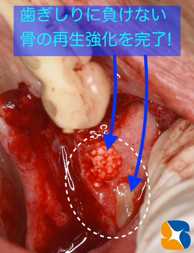 東大阪　奈良　石切駅前　鈴木歯科　ブルーラジカル　静脈麻酔鎮静　寝ながらリラックス　歯周病　インプラント　失った骨の再生医療　血液コラーゲン　歯科用最新CT精度が高い　正確な診査と診断 経験豊富