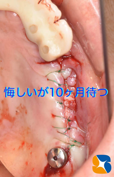 東大阪　奈良　石切駅前　鈴木歯科　ブルーラジカル　静脈麻酔鎮静　寝ながらリラックス　歯周病　インプラント　失った骨の再生医療　血液コラーゲン　歯科用最新CT精度が高い　正確な診査と診断 経験豊富