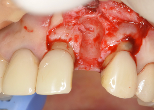 東大阪　奈良　石切駅前　鈴木歯科　ブルーラジカル　静脈麻酔鎮静　寝ながらリラックス　歯周病　インプラント　失った骨の再生医療　血液コラーゲン　歯科用最新CT精度が高い　正確な診査と診断 経験豊富