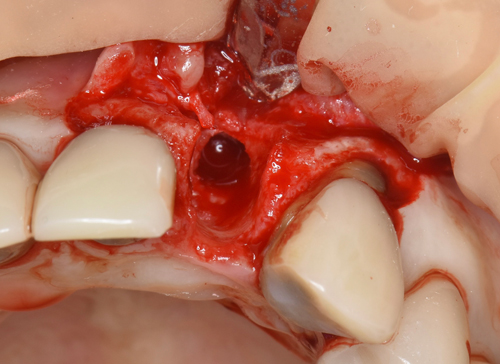 東大阪　奈良　石切駅前　鈴木歯科　ブルーラジカル　静脈麻酔鎮静　寝ながらリラックス　歯周病　インプラント　失った骨の再生医療　血液コラーゲン　歯科用最新CT精度が高い　正確な診査と診断 経験豊富