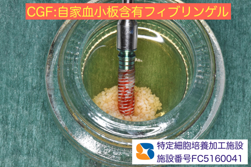 東大阪　奈良　石切駅前　鈴木歯科　ブルーラジカル　静脈麻酔鎮静　寝ながらリラックス　歯周病　インプラント　失った骨の再生医療　血液コラーゲン　歯科用最新CT精度が高い　正確な診査と診断 経験豊富