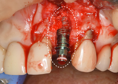東大阪　奈良　石切駅前　鈴木歯科　ブルーラジカル　静脈麻酔鎮静　寝ながらリラックス　歯周病　インプラント　失った骨の再生医療　血液コラーゲン　歯科用最新CT精度が高い　正確な診査と診断 経験豊富