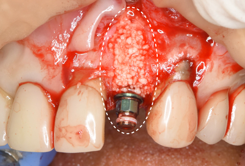 東大阪　奈良　石切駅前　鈴木歯科　ブルーラジカル　静脈麻酔鎮静　寝ながらリラックス　歯周病　インプラント　失った骨の再生医療　血液コラーゲン　歯科用最新CT精度が高い　正確な診査と診断 経験豊富