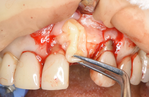 東大阪　奈良　石切駅前　鈴木歯科　ブルーラジカル　静脈麻酔鎮静　寝ながらリラックス　歯周病　インプラント　失った骨の再生医療　血液コラーゲン　歯科用最新CT精度が高い　正確な診査と診断 経験豊富