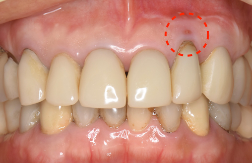 東大阪　奈良　石切駅前　鈴木歯科　ブルーラジカル　静脈麻酔鎮静　寝ながらリラックス　歯周病　インプラント　失った骨の再生医療　血液コラーゲン　歯科用最新CT精度が高い　正確な診査と診断 経験豊富