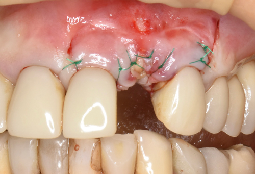 東大阪　奈良　石切駅前　鈴木歯科　ブルーラジカル　静脈麻酔鎮静　寝ながらリラックス　歯周病　インプラント　失った骨の再生医療　血液コラーゲン　歯科用最新CT精度が高い　正確な診査と診断 経験豊富