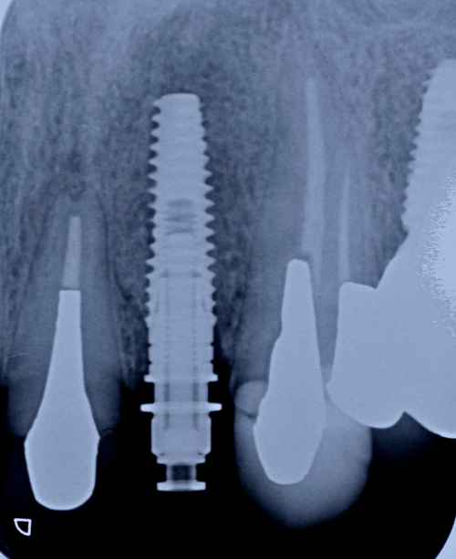 東大阪　奈良　石切駅前　鈴木歯科　ブルーラジカル　静脈麻酔鎮静　寝ながらリラックス　歯周病　インプラント　失った骨の再生医療　血液コラーゲン　歯科用最新CT精度が高い　正確な診査と診断 経験豊富