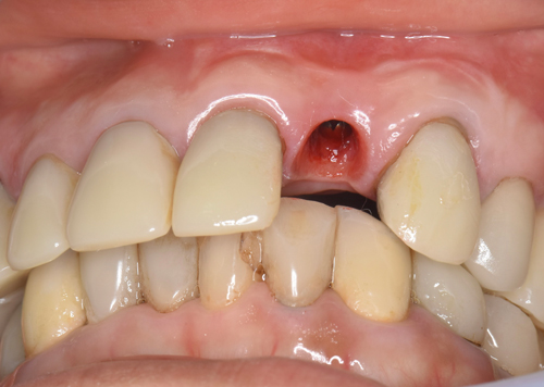 東大阪　奈良　石切駅前　鈴木歯科　ブルーラジカル　静脈麻酔鎮静　寝ながらリラックス　歯周病　インプラント　失った骨の再生医療　血液コラーゲン　歯科用最新CT精度が高い　正確な診査と診断 経験豊富