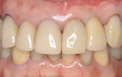 東大阪　奈良　石切駅前　鈴木歯科　ブルーラジカル　静脈麻酔鎮静　寝ながらリラックス　歯周病　インプラント　失った骨の再生医療　血液コラーゲン　歯科用最新CT精度が高い　正確な診査と診断 経験豊富