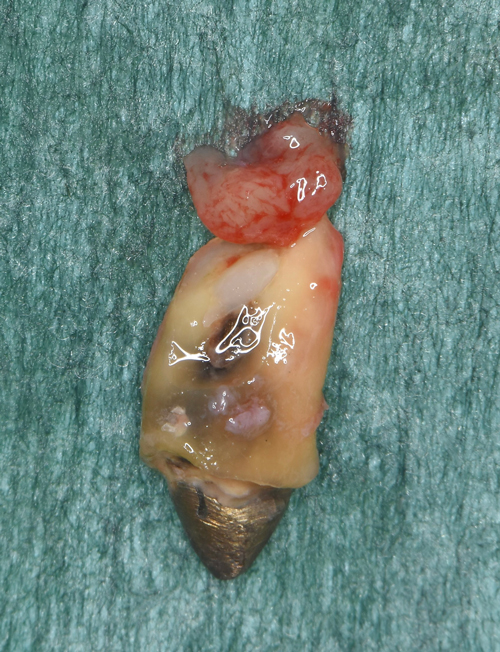 東大阪　奈良　石切駅前　鈴木歯科　ブルーラジカル　静脈麻酔鎮静　寝ながらリラックス　歯周病　インプラント　失った骨の再生医療　血液コラーゲン　歯科用最新CT精度が高い　正確な診査と診断 経験豊富