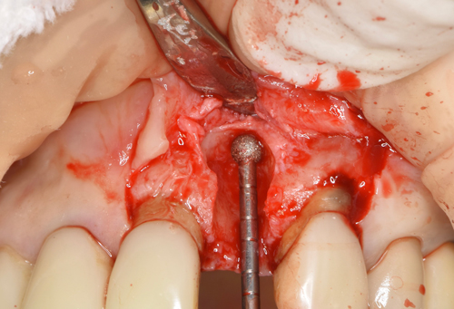 東大阪　奈良　石切駅前　鈴木歯科　ブルーラジカル　静脈麻酔鎮静　寝ながらリラックス　歯周病　インプラント　失った骨の再生医療　血液コラーゲン　歯科用最新CT精度が高い　正確な診査と診断 経験豊富