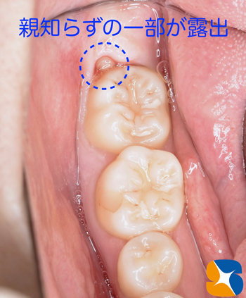 東大阪　奈良　石切駅前　鈴木歯科　ブルーラジカル　静脈麻酔鎮静　寝ながらリラックス　歯周病　インプラント　失った骨の再生医療　血液コラーゲン　歯科用最新CT精度が高い　正確な診査と診断