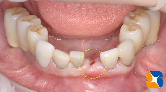 東大阪　奈良　石切駅前　鈴木歯科　ブルーラジカル　静脈麻酔鎮静　寝ながらリラックス　歯周病　インプラント　失った骨の再生医療　血液コラーゲン　歯科用最新CT精度が高い　正確な診査と診断
