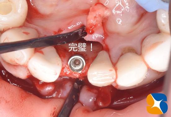 東大阪　奈良　石切駅前　鈴木歯科　ブルーラジカル　静脈麻酔鎮静　寝ながらリラックス　歯周病　インプラント　失った骨の再生医療　血液コラーゲン　歯科用最新CT精度が高い　正確な診査と診断