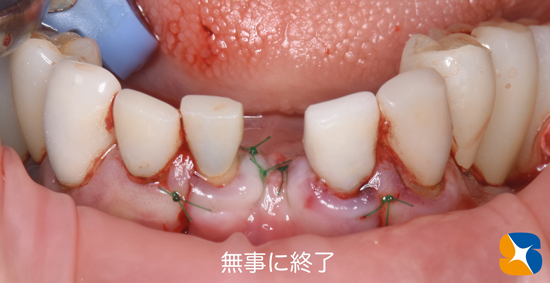 東大阪　奈良　石切駅前　鈴木歯科　ブルーラジカル　静脈麻酔鎮静　寝ながらリラックス　歯周病　インプラント　失った骨の再生医療　血液コラーゲン　歯科用最新CT精度が高い　正確な診査と診断
