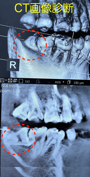 東大阪　奈良　石切駅前　鈴木歯科　ブルーラジカル　静脈麻酔鎮静　寝ながらリラックス　歯周病　インプラント　失った骨の再生医療　血液コラーゲン　歯科用最新CT精度が高い　正確な診査と診断