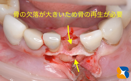 東大阪　奈良　石切駅前　鈴木歯科　ブルーラジカル　静脈麻酔鎮静　寝ながらリラックス　歯周病　インプラント　失った骨の再生医療　血液コラーゲン　歯科用最新CT精度が高い　正確な診査と診断