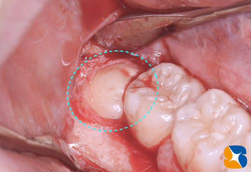 東大阪　奈良　石切駅前　鈴木歯科　ブルーラジカル　静脈麻酔鎮静　寝ながらリラックス　歯周病　インプラント　失った骨の再生医療　血液コラーゲン　歯科用最新CT精度が高い　正確な診査と診断