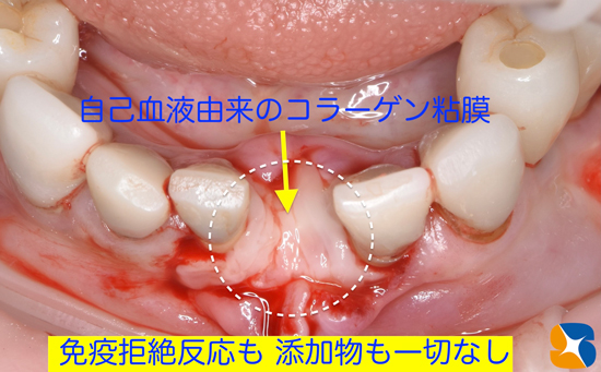 東大阪　奈良　石切駅前　鈴木歯科　ブルーラジカル　静脈麻酔鎮静　寝ながらリラックス　歯周病　インプラント　失った骨の再生医療　血液コラーゲン　歯科用最新CT精度が高い　正確な診査と診断
