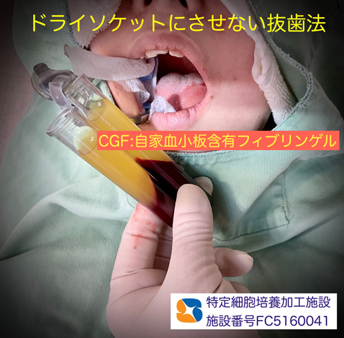 東大阪　奈良　石切駅前　鈴木歯科　ブルーラジカル　静脈麻酔鎮静　寝ながらリラックス　歯周病　インプラント　失った骨の再生医療　血液コラーゲン　歯科用最新CT精度が高い　正確な診査と診断